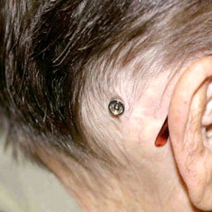 BAHA (Bone Anchored Hearing Aid) BAHA (Bone Anchored Hearing Aid)