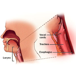 Cancer Of Larynx