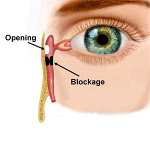 Dacryocystorhinostomy (DCR) Dacryocystorhinostomy (DCR)