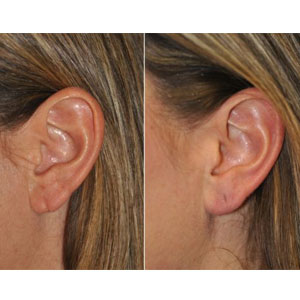 Earlobe Repair Surgical Earlobe Repair Surgical