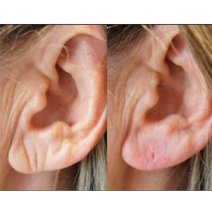 Ear Lobe Repair With Fillers Ear Lobe Repair With Fillers