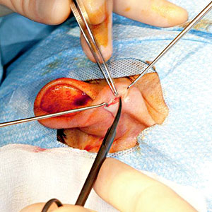 Endoscopic Ear Surgery Endoscopic Ear Surgery