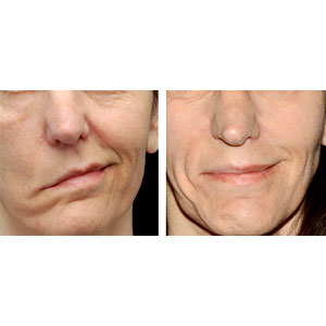 Facial Nerve Decompression Facial Nerve Decompression