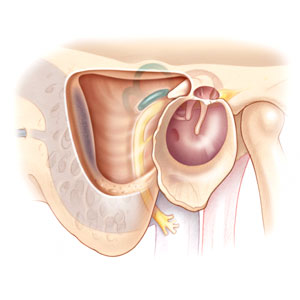 Mastoidectomy Mastoidectomy