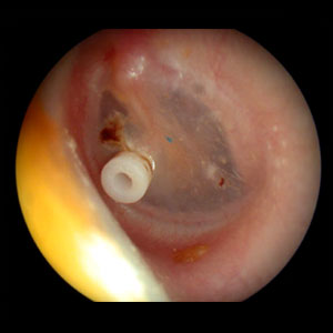 Myringotomy With Gromet Insertion Myringotomy With Gromet Insertion