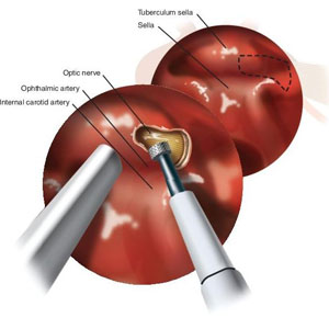 Optic Nerve Decompression Optic Nerve Decompression