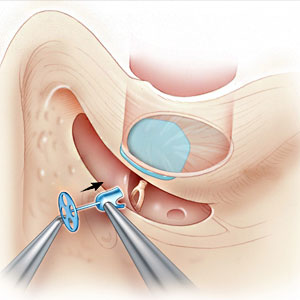 Ossiculoplasty Ossiculoplasty