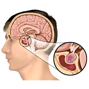 Pituitary Tumors Pituitary Tumors