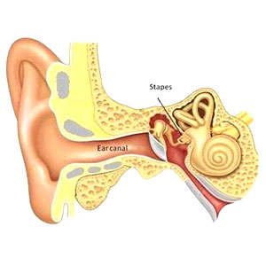 Otosclerosis Otosclerosis