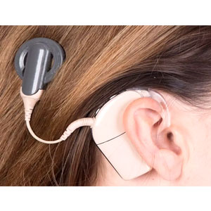 Vestibular Implant Vestibular Implant