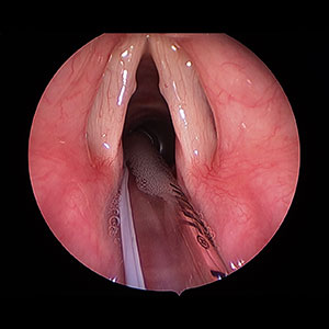 Vocal Nodule Vocal Nodule