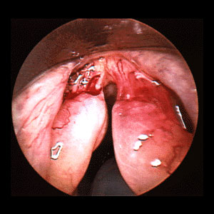 Vocal Polyp Vocal Polyp