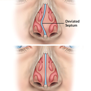Septoplasty Septoplasty