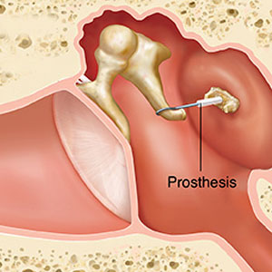 Middle Ear Prosthesis Middle Ear Prosthesis